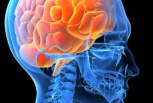 Enfermedad Vascular Cerebral