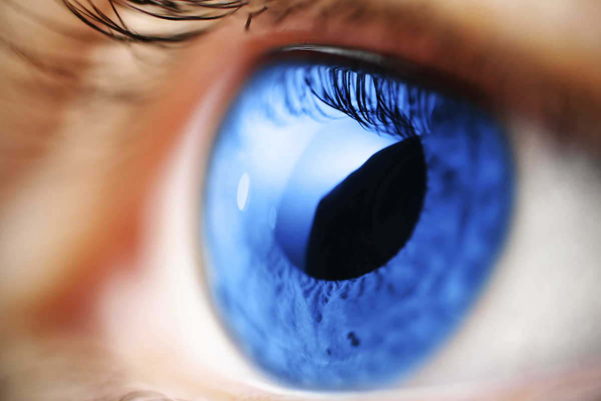 glaucoma