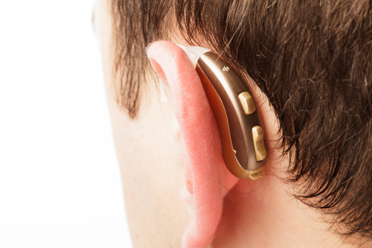 Los implantes cocleares, alternativa ante  pérdida auditiva avanzada.