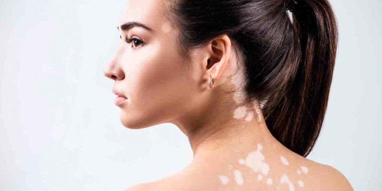 Vitiligo: La pérdida del color en la piel.