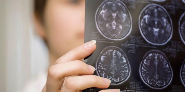 La teoría sobre el origen del Alzheimer.
