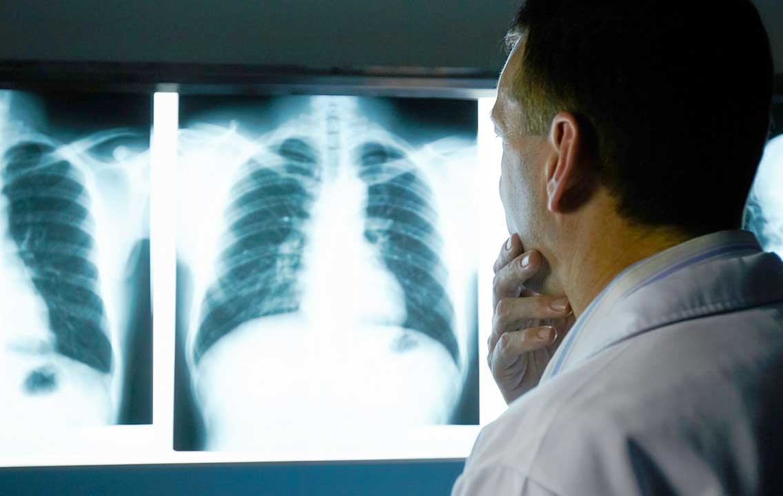 cáncer de pulmón