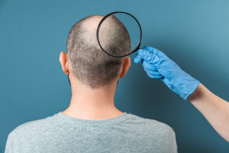 Alopecia areata, un trastorno autoinmune que puede causa la pérdida de cabello.